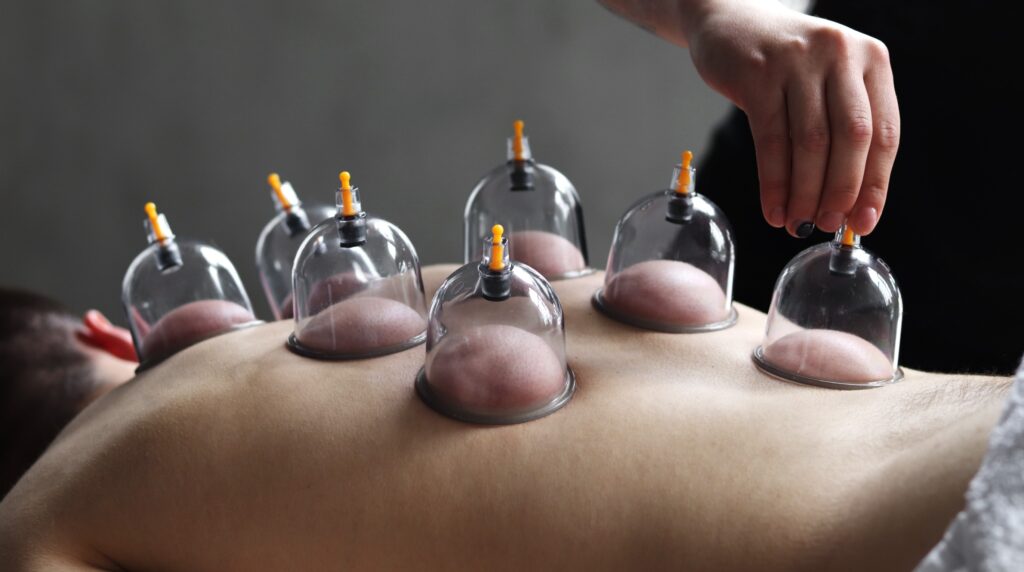 Cupping therapy, cupping terapi